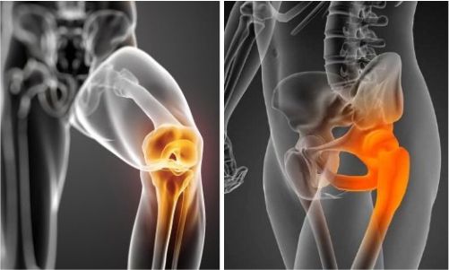 Artrosis de cadera rodilla y hombro